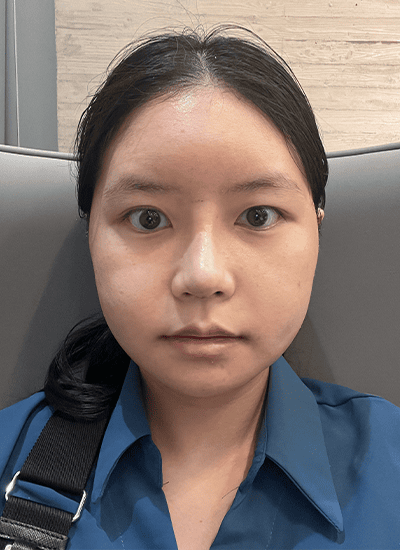 面部轮廓手术术后第七天正面