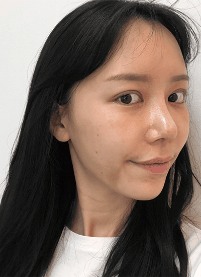 眼部整形+鼻部整形手术二周后侧面