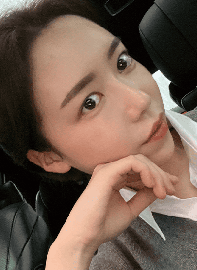 眼部整形+鼻部整形手术七个月后侧面