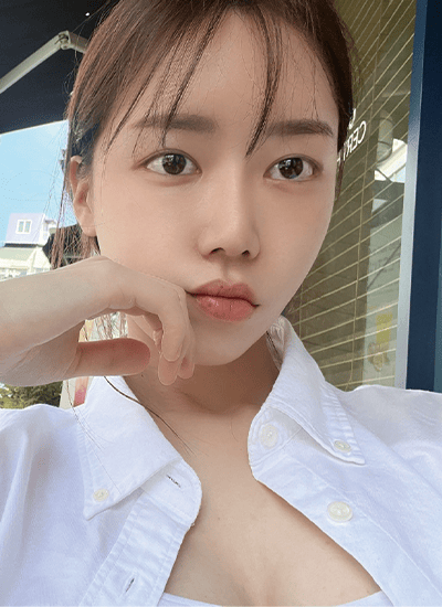 眼部整形+鼻部整形手术八个月后正面