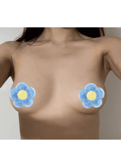 隆胸手术手术前正面