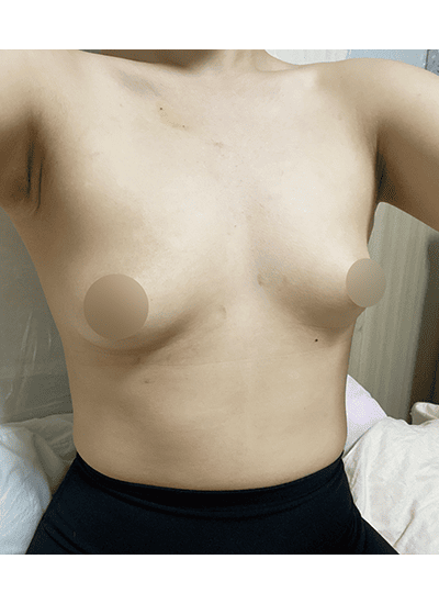 隆胸手术手术前