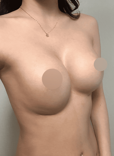 胸部修复手术手术前侧面