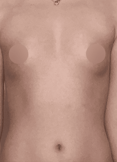 隆胸手术手术前正面