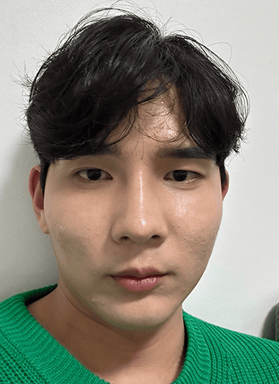 男士轮廓整形手术前正面