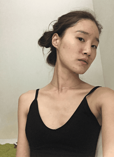 隆鼻手术手术前侧面