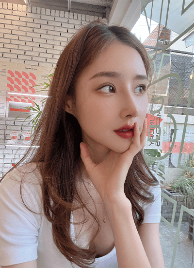 隆鼻手术二周后侧面