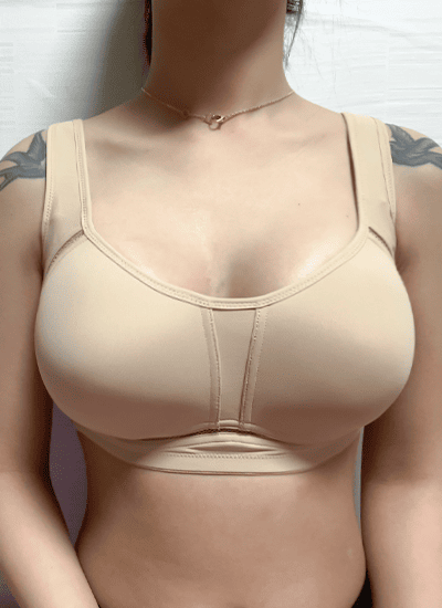 隆胸手术两周后