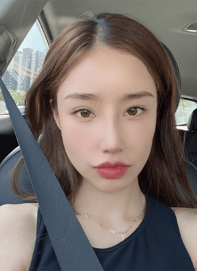 隆鼻手术三周后正面