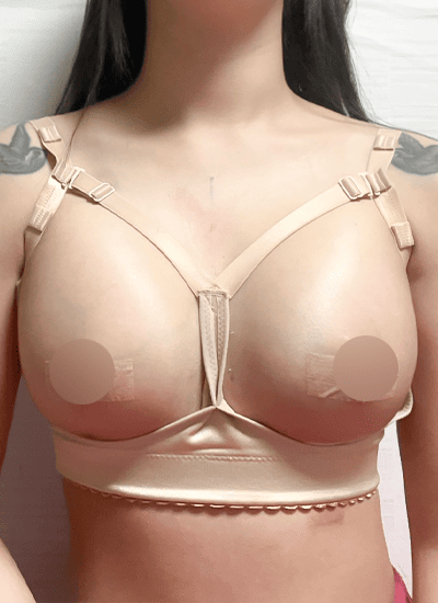 隆胸手术三天后正面