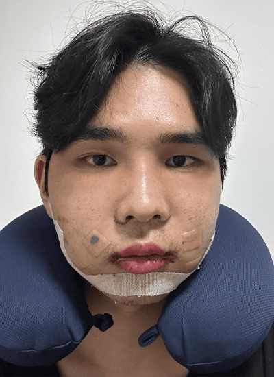 男士轮廓整形手术三天后正面