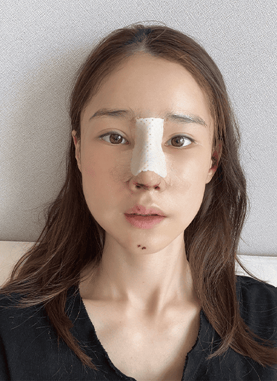 隆鼻手术三天后正面