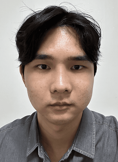 男士轮廓整形手术七天后正面