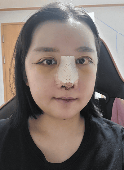 面部轮廓+鼻部整形+眼部整形术后第三天