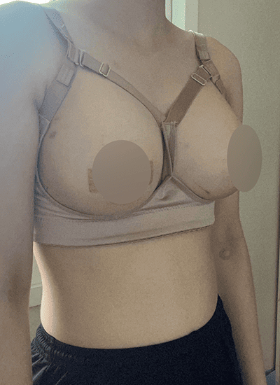 隆胸手术手术一周后侧面