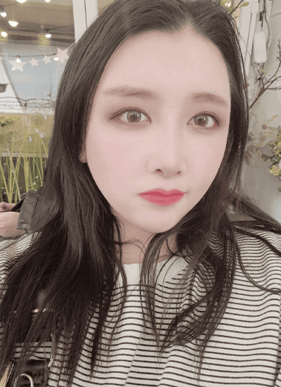 面部轮廓+鼻部整形+眼部整形术后十个月正面