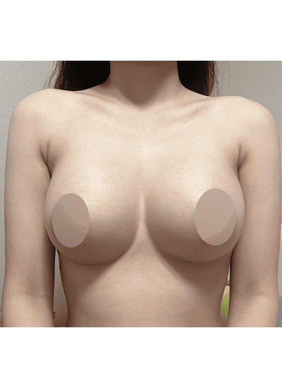 隆胸手术手术四个月后正面