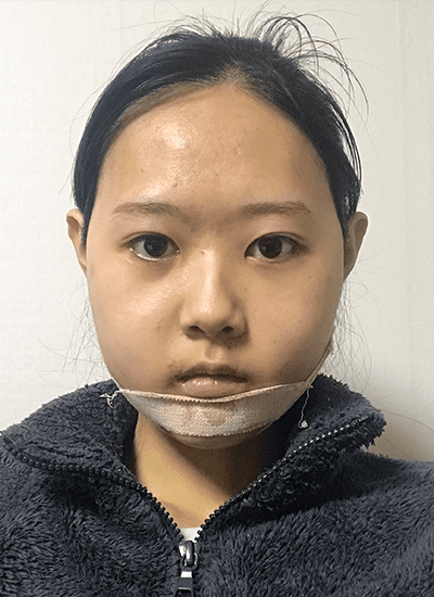 面部轮廓手术一周后正面