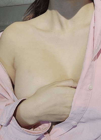 隆胸手术手术后十一个月