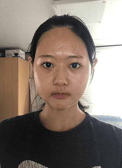 面部轮廓手术三周后正面