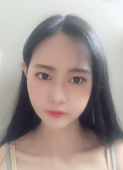 面部轮廓手术六个月后正面