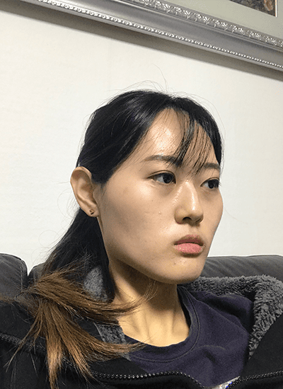 面部轮廓手术前侧面