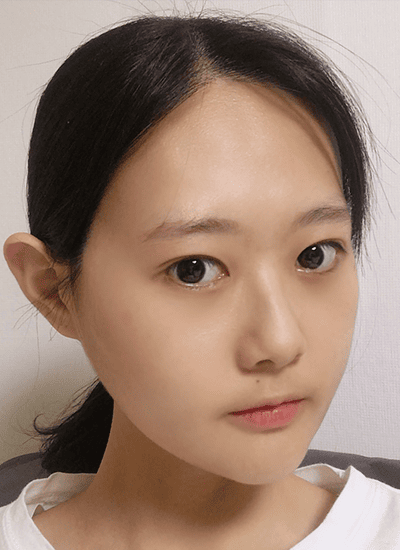 面部轮廓手术四个月后