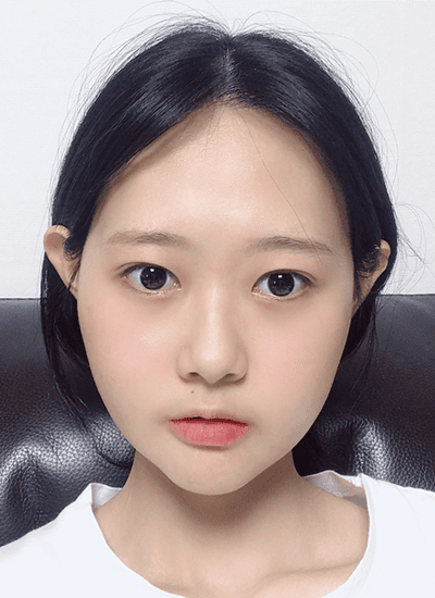 面部轮廓手术三个月后正面