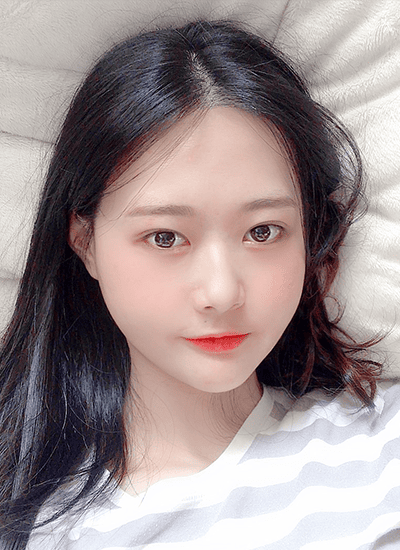 面部轮廓手术二个月后正面