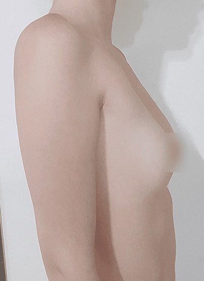 隆胸手术手术前侧面