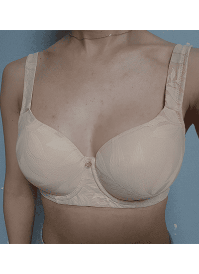 隆胸手术手术十个月后正面