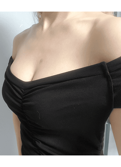 隆胸手术手术十一个月后侧面