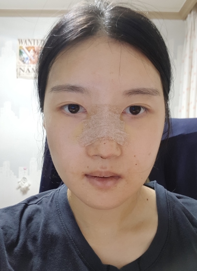 隆鼻手术+轮廓三件套手术一周后正面