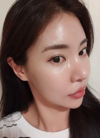 鼻部修复手术手术二个月后