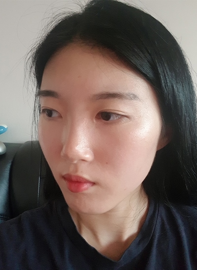 隆鼻手术+轮廓三件套手术前侧面