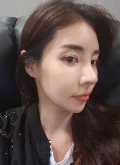 鼻部修复手术手术二周后