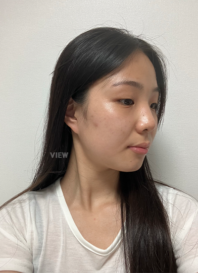 轮廓三件套、鼻部手术手术前侧面