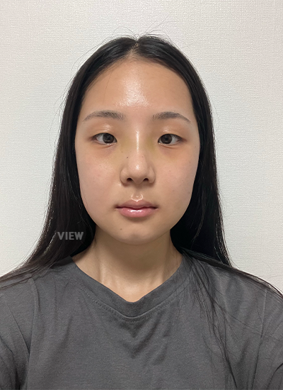 轮廓三件套、鼻部手术手术二周后正面