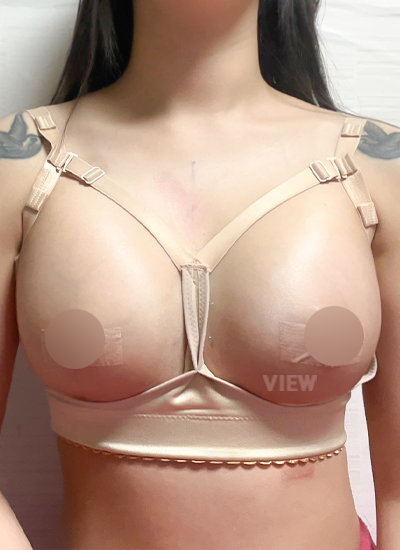 隆胸手术手术三天后正面