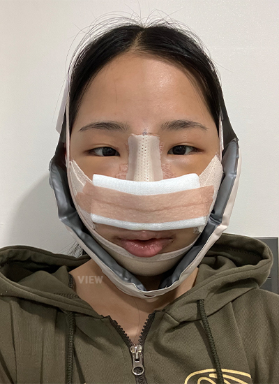 轮廓三件套、鼻部手术手术三天后正面