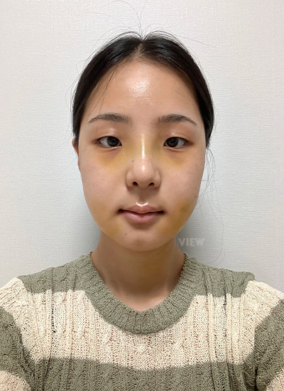 轮廓三件套、鼻部手术手术一周后正面