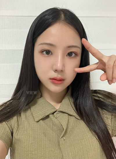 轮廓三件套、眼部修复手术、鼻部手术手术二个月后