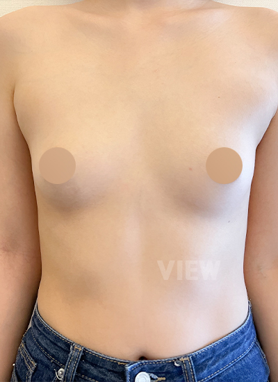 隆胸手术手术前正面