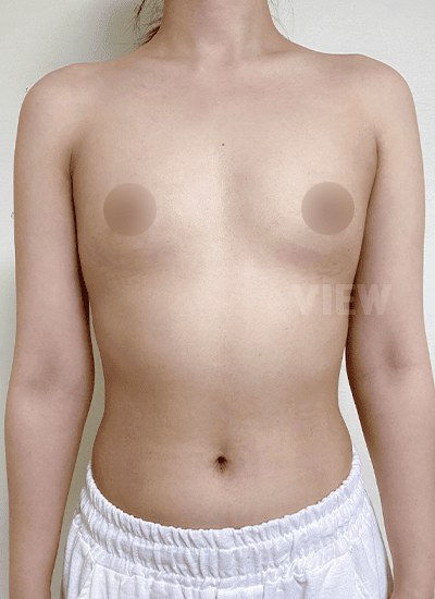 隆胸手术手术前