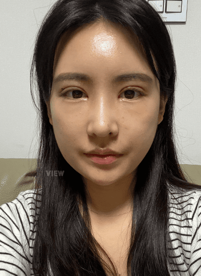 面部轮廓、鼻部整形、眼部整形手术二周后正面