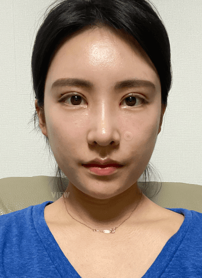 面部轮廓、鼻部整形、眼部整形手术三周后正面