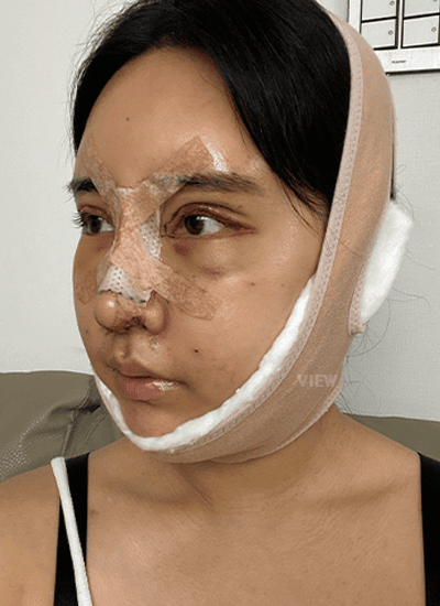 面部轮廓、鼻部整形、眼部整形手术三天后侧面