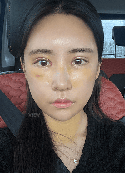 面部轮廓、鼻部整形、眼部整形手术一周后正面