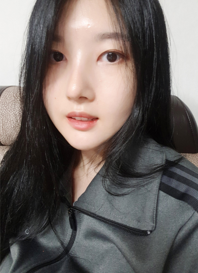 隆鼻手术+轮廓三件套手术一个月后