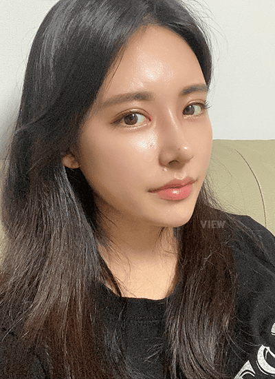 面部轮廓、鼻部整形、眼部整形手术一个月后